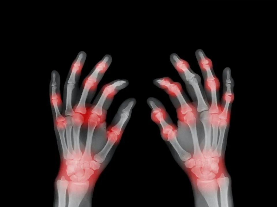 Rheumatoid arthritis leads to painful joint inflammation, often in the hands and wrists.