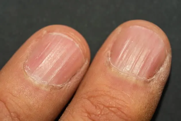 Ridges, known as onychorrhexis, tend to occur under your nails as you age. 